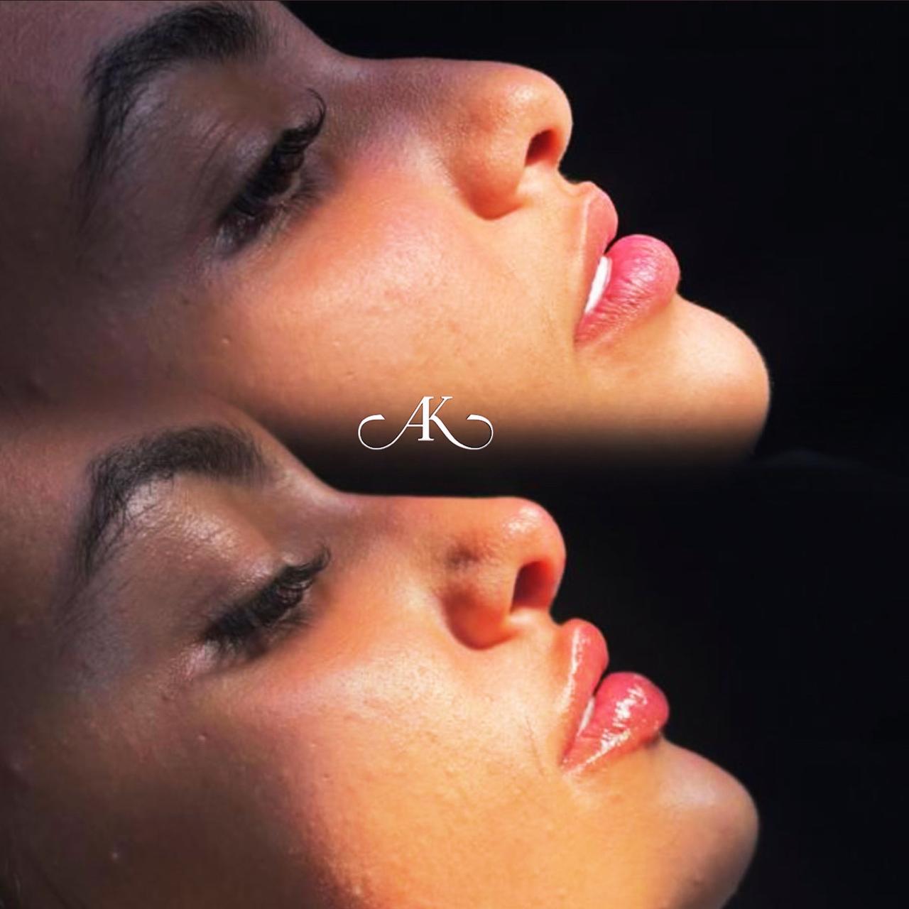 Antes e Depois de Rinomodelação