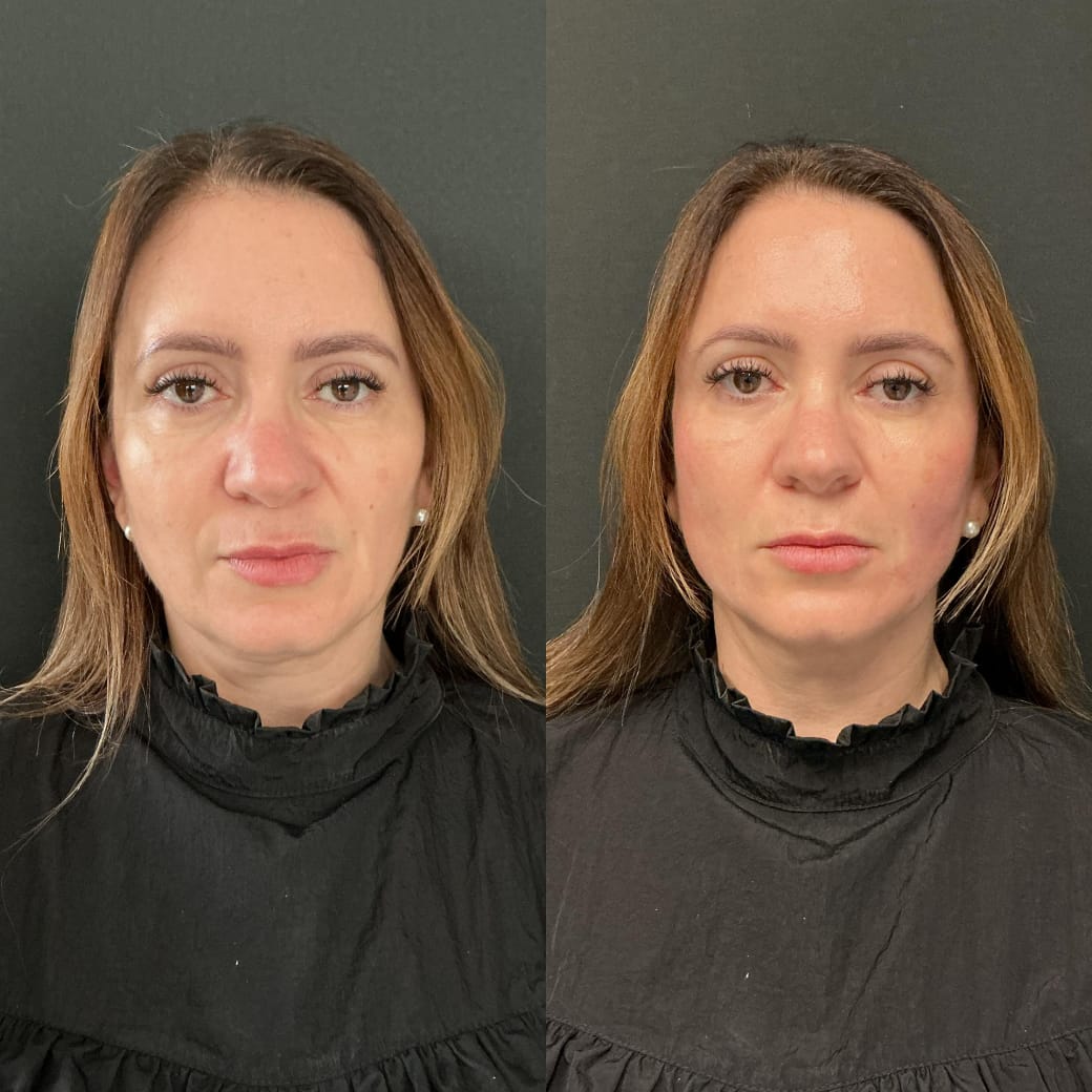 Bioestimulador de Colágeno - Tratamento