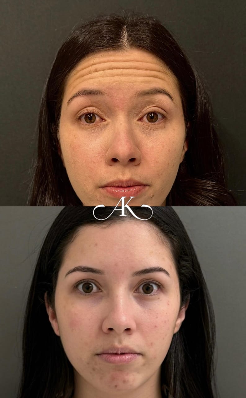 Botox Depois - Suavização de Rugas