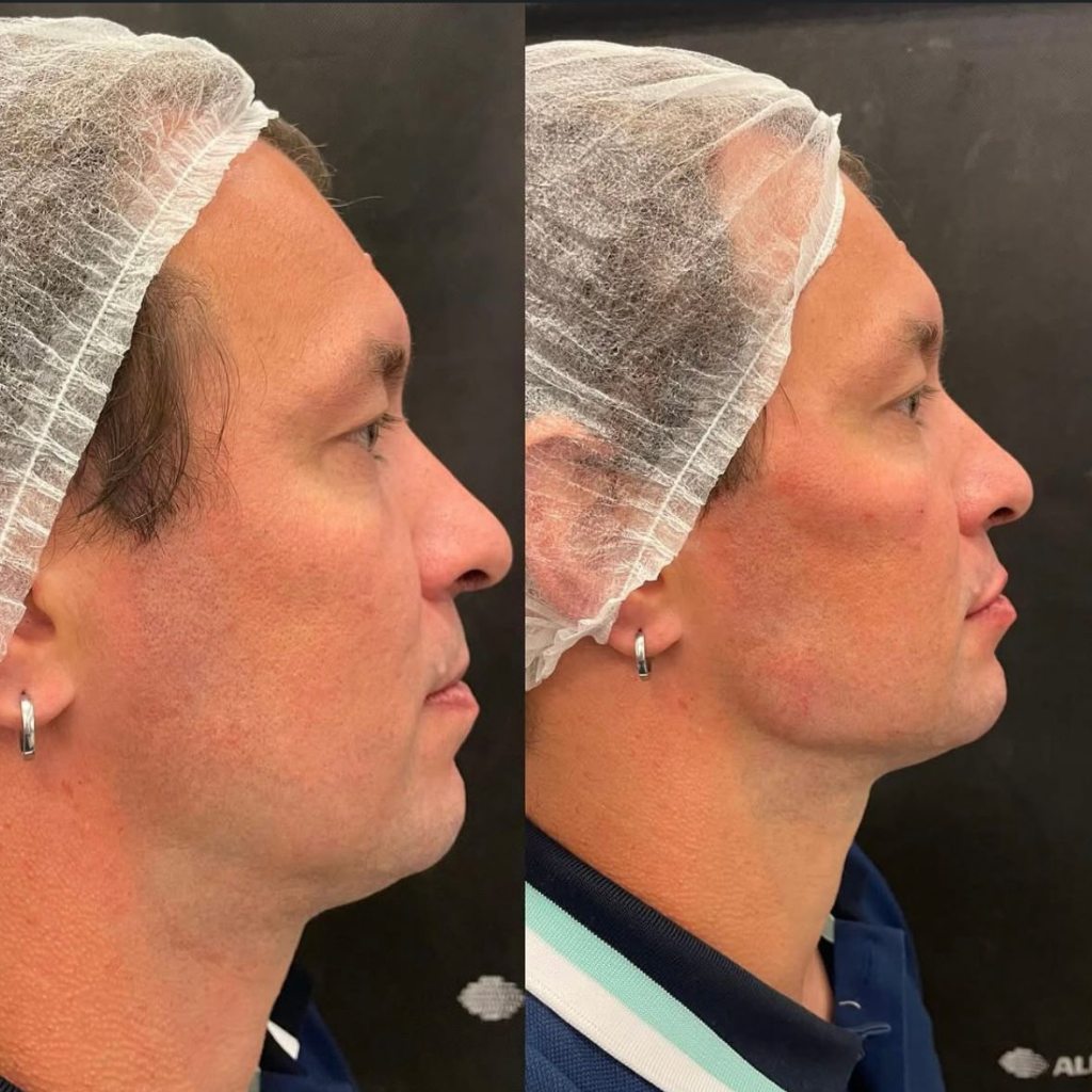 Contorno Mandibular - Marcação da mandíbula