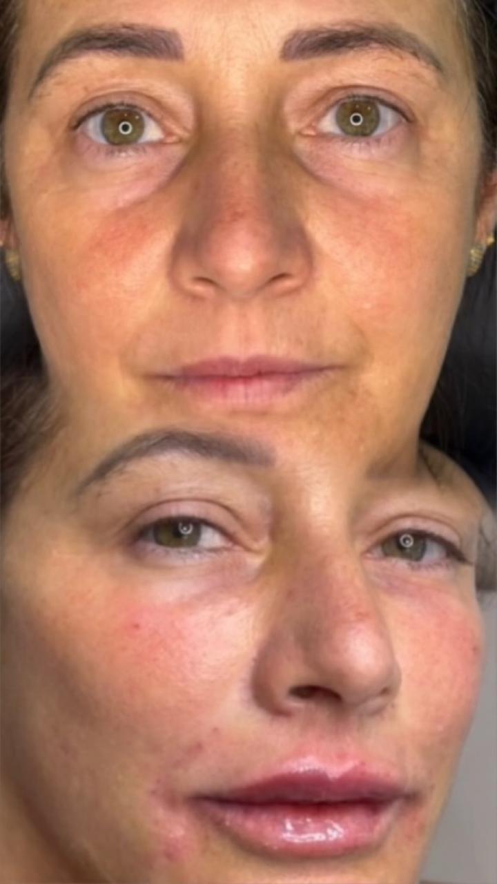 Procedimento Full Face - Harmonização