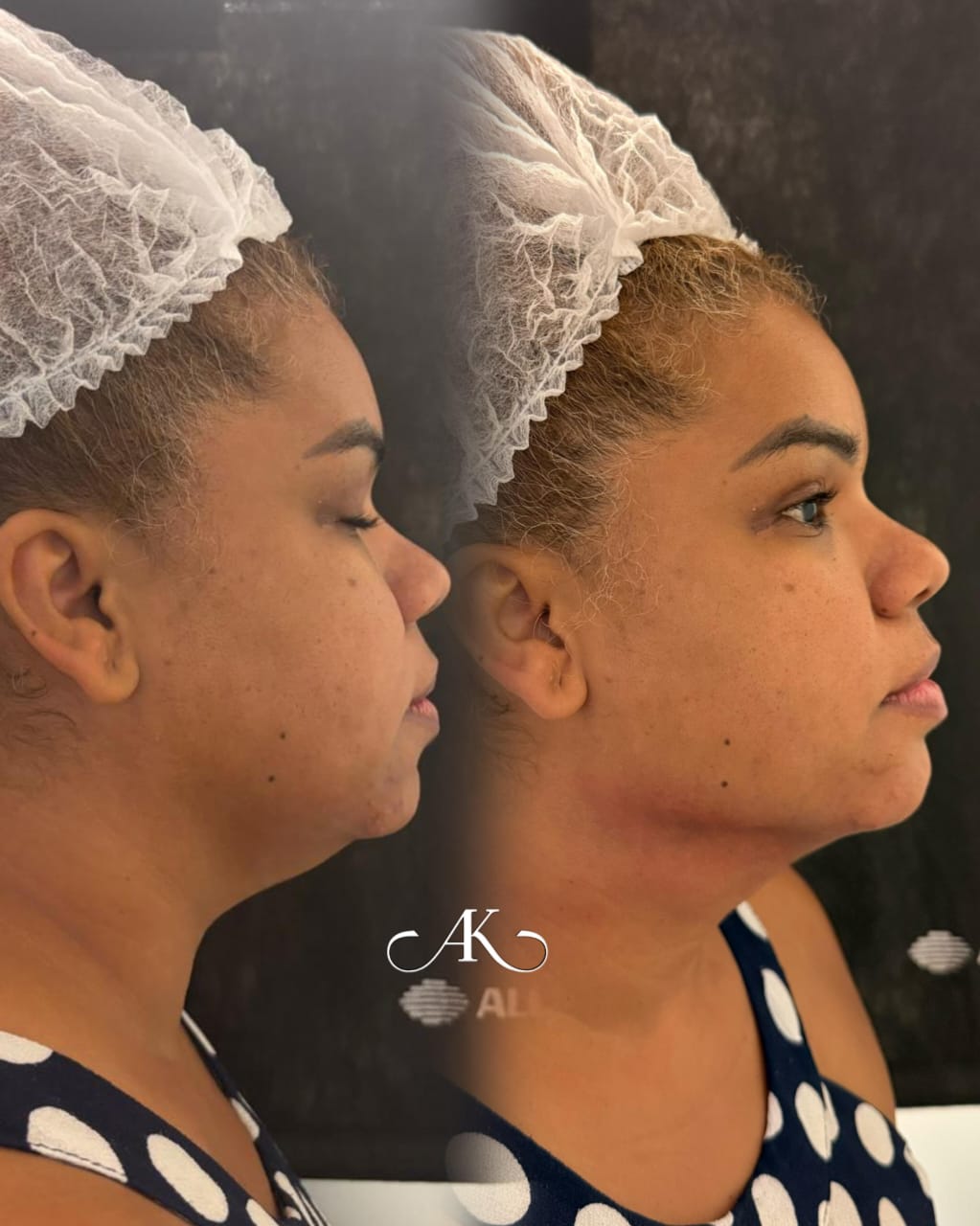 Lipo de Papada - Antes e Depois