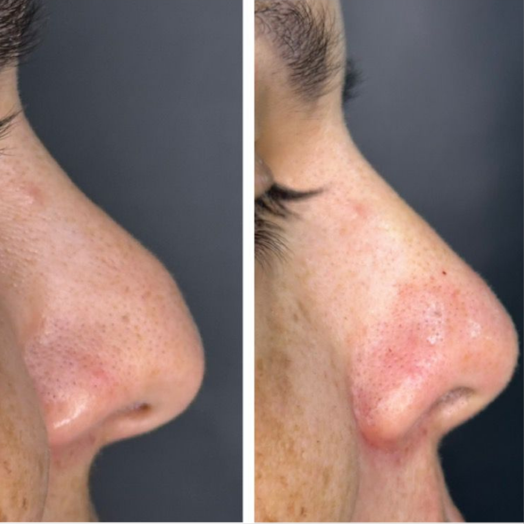 Rinomodelação Depois - Nariz Reto e Ponta Elevada